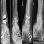 Plotting a Pathway to Recovery After Foot or Ankle Surgery